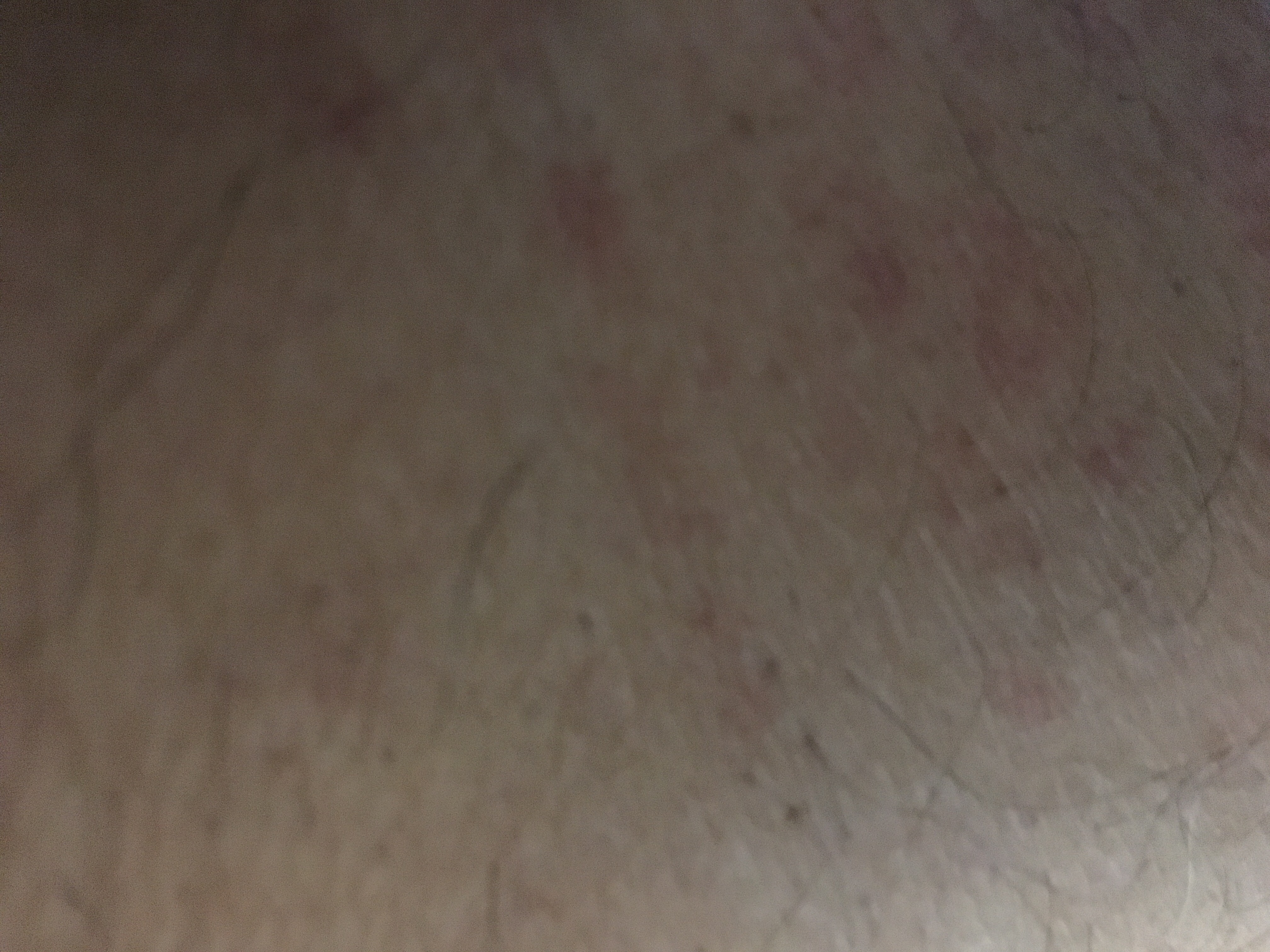 Is it Dengue?